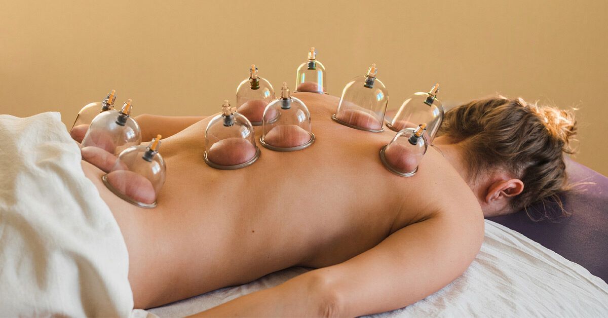 Technique de ventousothérapie appliquée sur le dos
