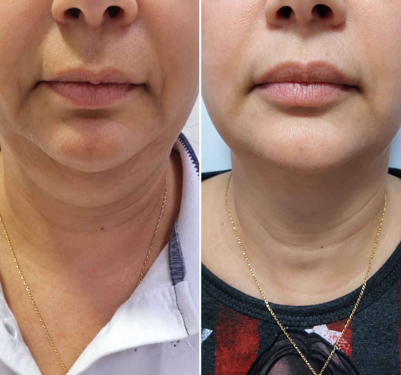 Marie, 58 ans - résultat réel