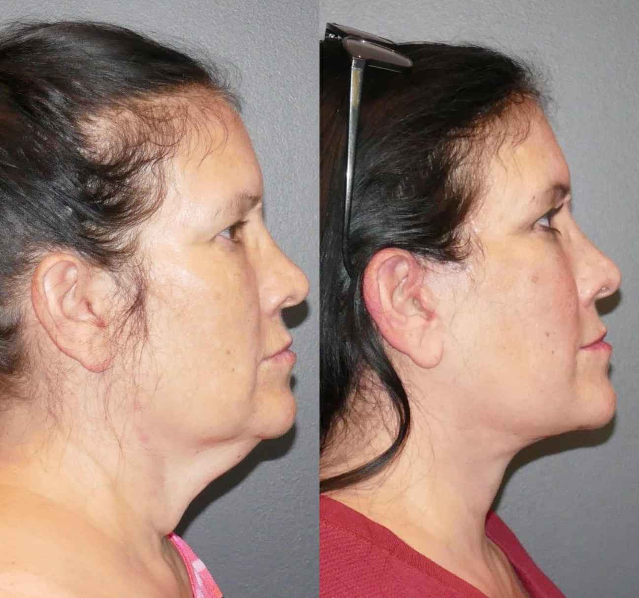 Sophie, 47 ans - résultat réel